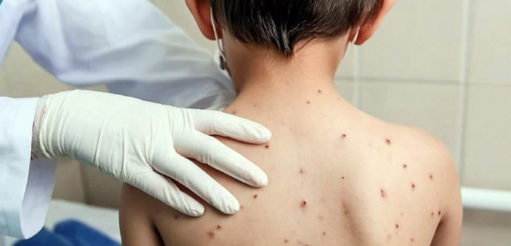 Measles reaches Lakeside as Jalisco cases top four hundred